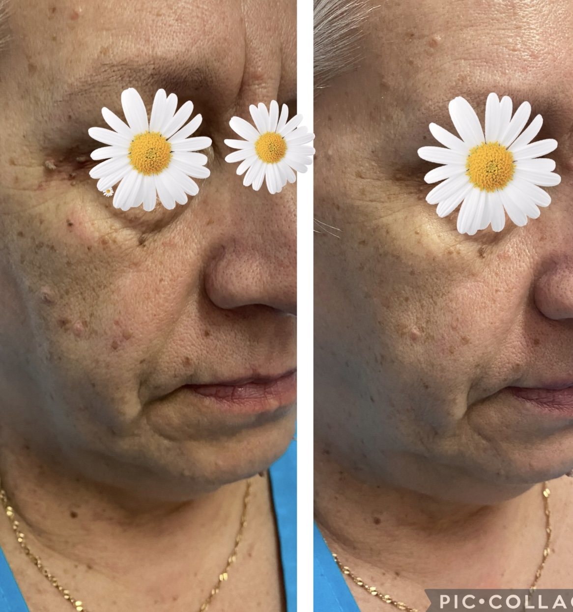 IMG 9162 2 laser włók