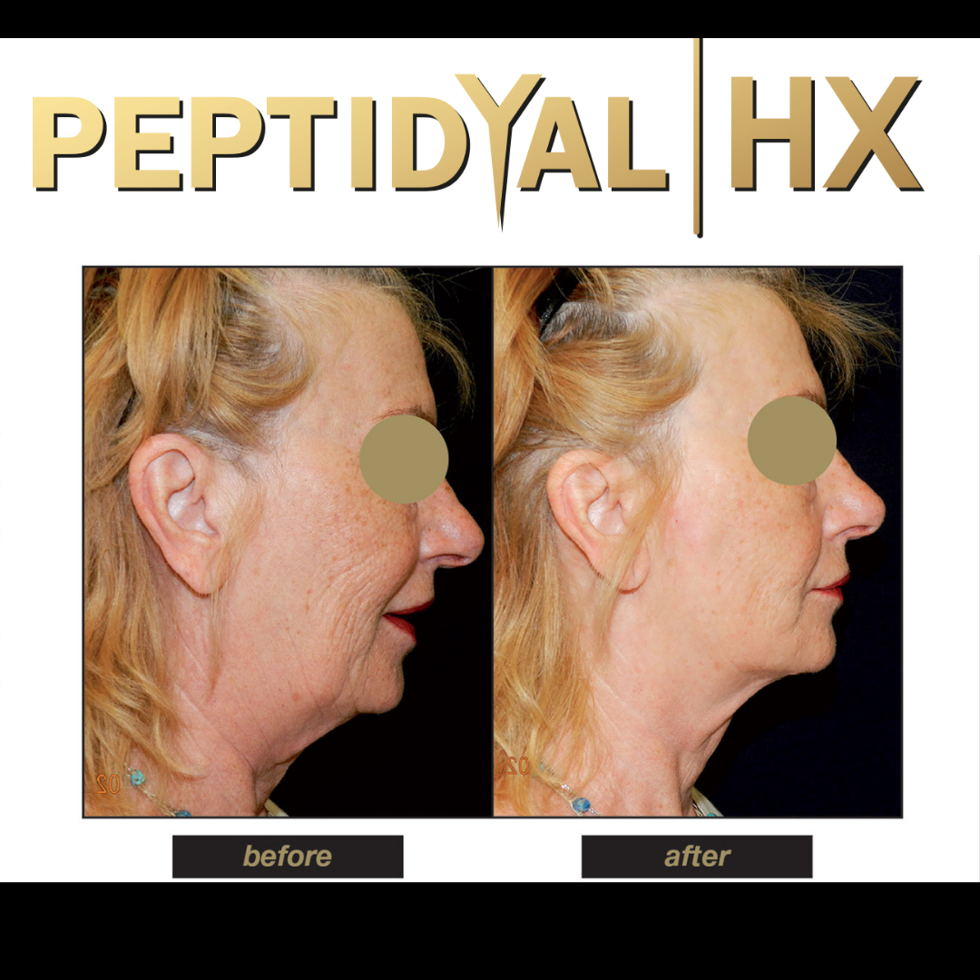 Peptidyal HX 1